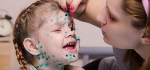 Ветрянка у детей — Полезная информация